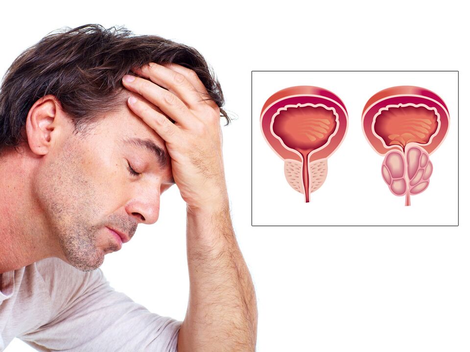 prostatas adenoma ar impotenci